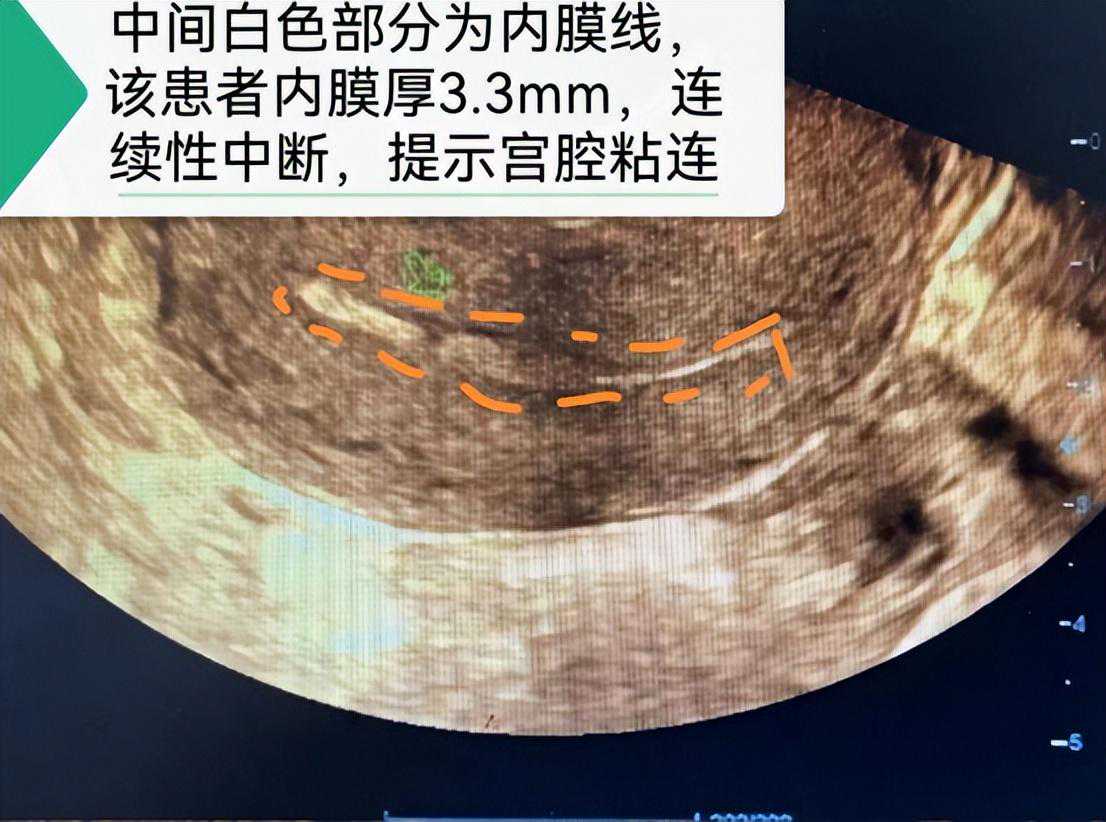 43岁女性宫腔粘连多次试管失败，术后顺利妊娠产子