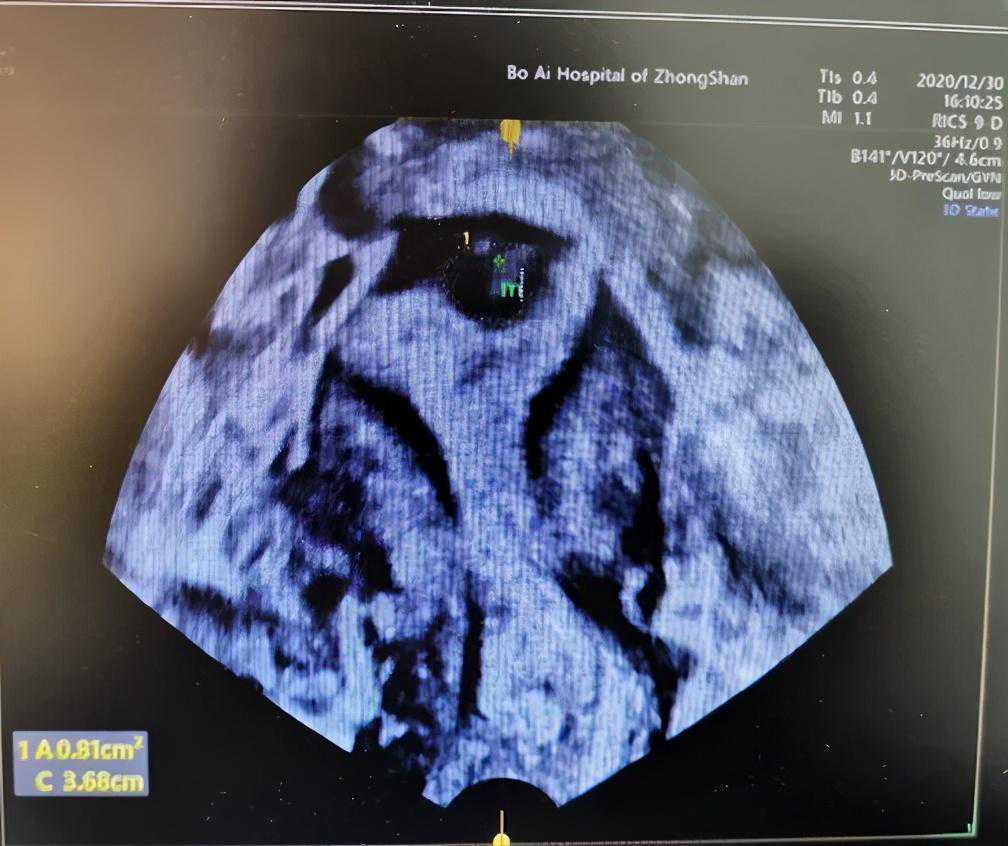 女子多年未孕，多次试管失败！医生用“冷刀”解决拦路虎
