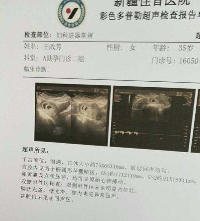 双胞胎试管婴儿受孕成功后的孕期分享（二）