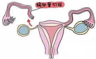 备孕指南-只剩一侧输卵管，还能怀宝宝吗？