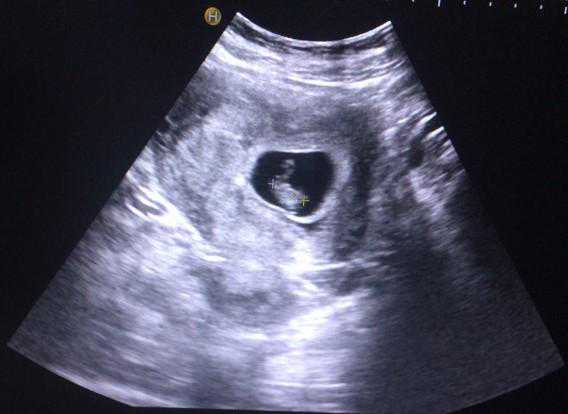 第30讲，孕期超声指标怎么看（1）？