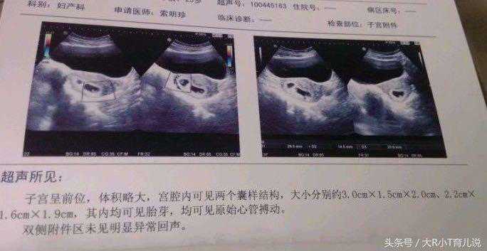 接到医生的电话，唐氏筛查临界风险，婆婆安慰我说不影响，但整个孕期我不知哭了多少回～