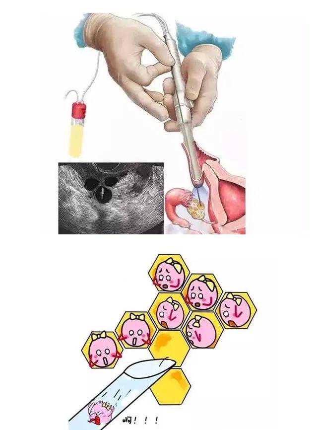 试管婴儿全流程，提前规划，备孕工作两不误